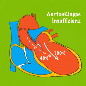 Nicht mehr ganz dicht, Aortenklappe?