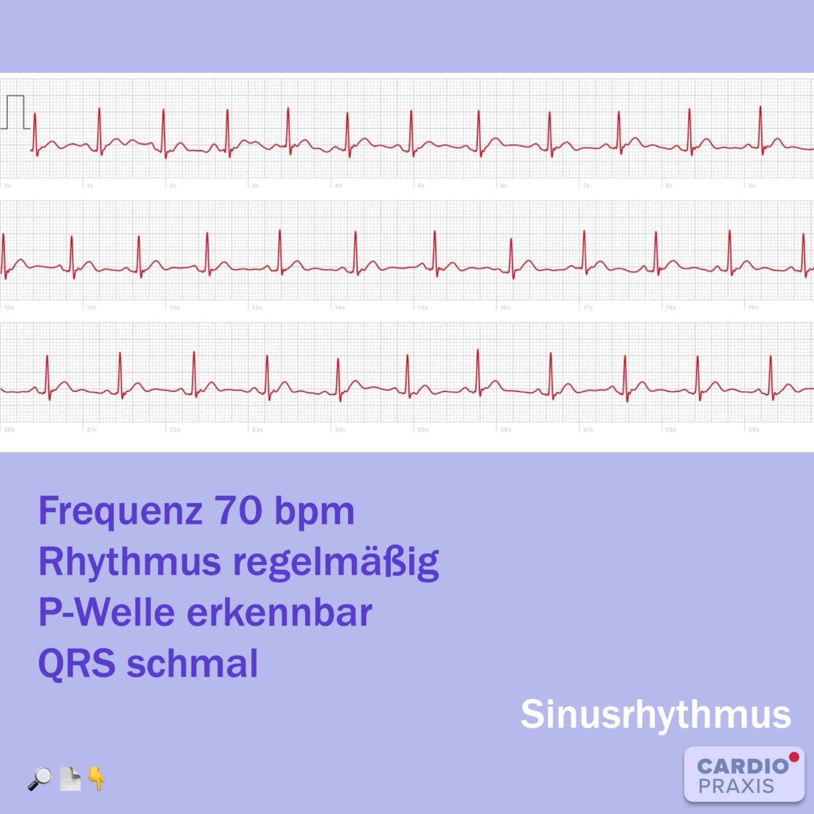 Normaler Puls Sinusrhythmus Smartphone EKG Routinemessung