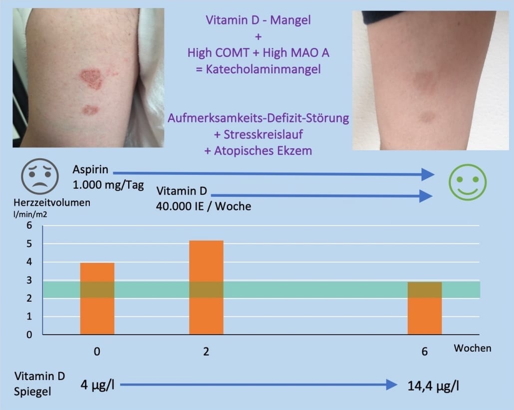 Aufmerksamkeits Defizit Störung