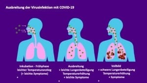 Corona Virusinfektion