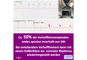 Vorhofflimmern