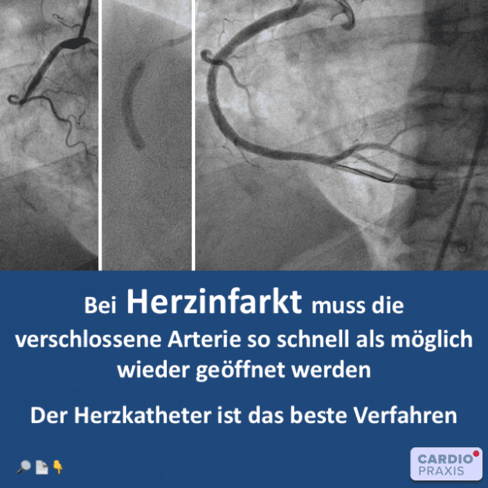 Herzkatheter: die beste Therapie bei Herzinfarkt | | Cardiopraxis®