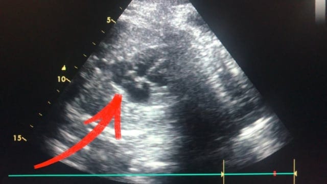 PFO: Warum manche Menschen ein Loch im Herzen haben - Cardiopraxis