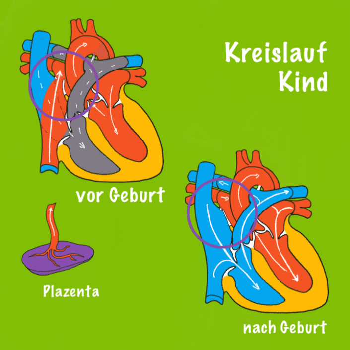 PFO Warum manche Menschen ein Loch im Herzen haben Cardiopraxis®