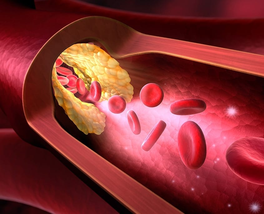 Angina Pectoris: Verstopfung der Herzkranzgefäße | Cardiopraxis - Ihre Praxis für Kardiologie in Düsseldorf und Meerbusch
