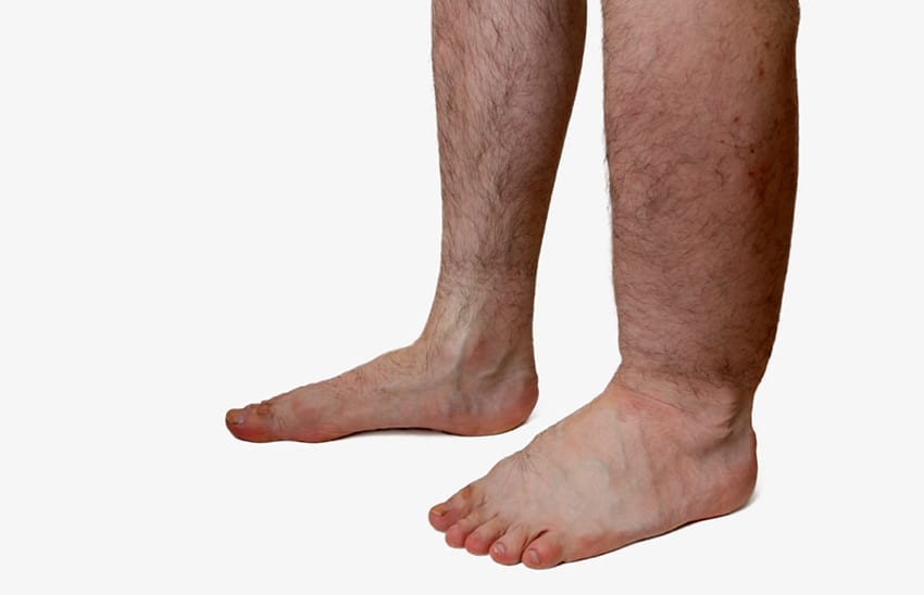 Abbildung zeigt einseiti ausgeprägtes Beinödem