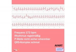 EKG mit Smartphone/Smartwatch erstellen