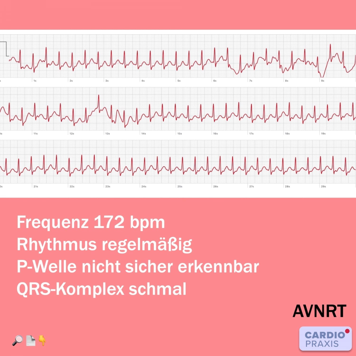 Herzrasen - plötzlicher schneller Herzschlag | | Cardiopraxis®