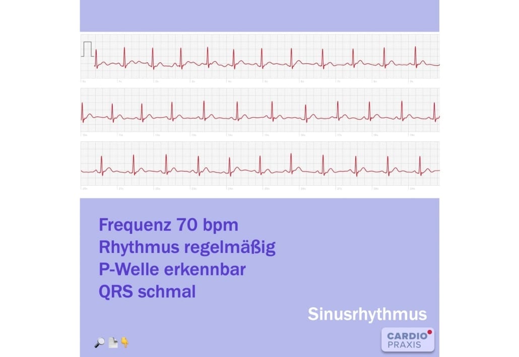 Normaler Puls - Sinusrhythmus - Smartphone EKG Routinemessung ...