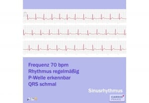 EKG mit Smartphone/Smartwatch erstellen