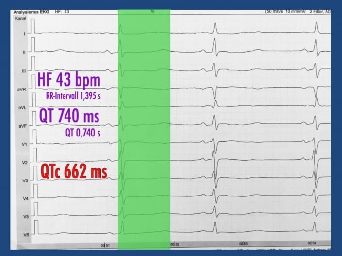 QT-Zeit im EKG - Nebenwirkungen von Medikamenten | | Cardiopraxis®