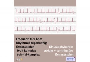 EKG mit Smartphone/Smartwatch erstellen