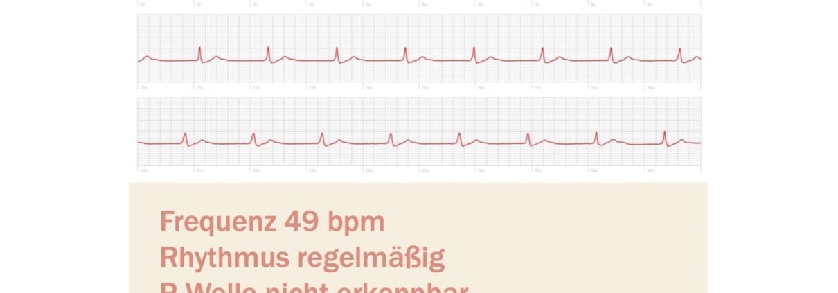 Übelkeit und Speichelfluss am Morgen - EKG Apple Watch 5 ...