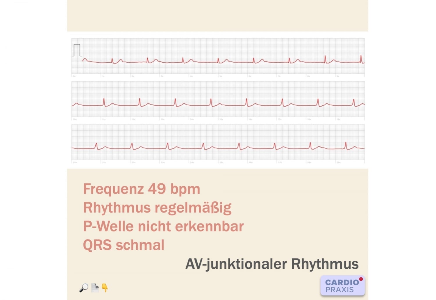 Vorhofflimmern Apple Watch Ekg Beispiele www.cardiopraxis.de