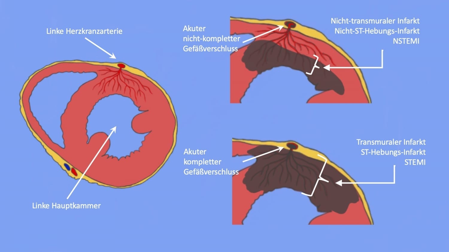 Ein Herzinfarkt kann verschiedene Ursachen haben | | Cardiopraxis®