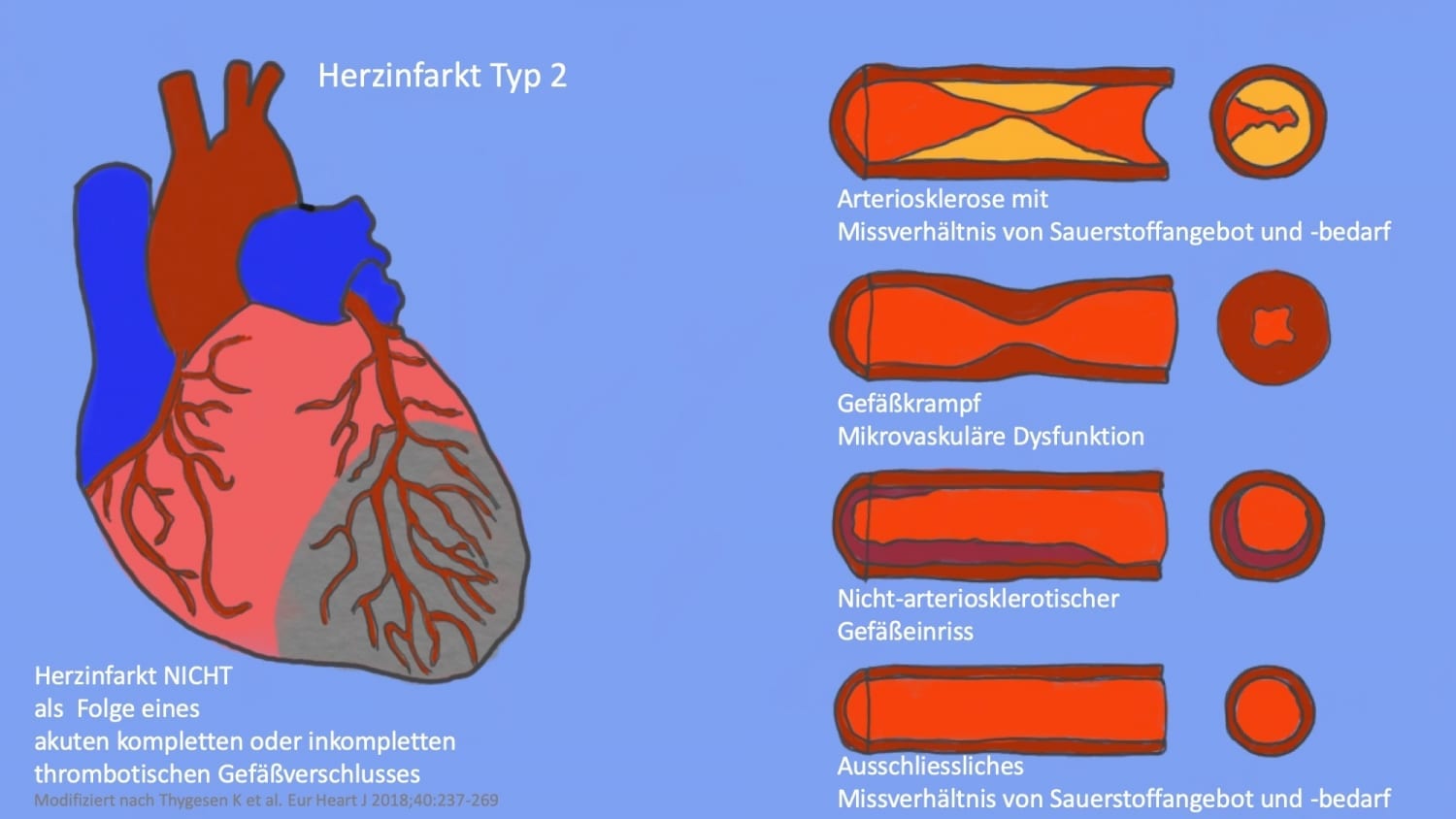 Ein Herzinfarkt kann verschiedene Ursachen haben Cardiopraxis®