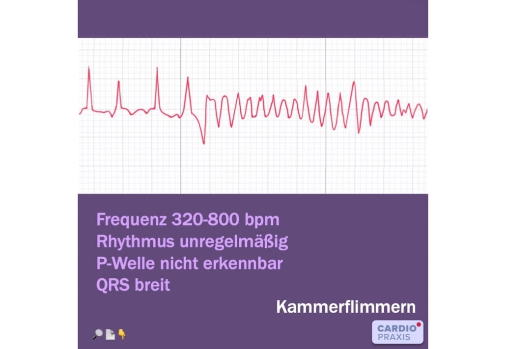 Kammerflimmern im Langzeit-EKG - Plötzlicher Herztod - Cardiopraxis