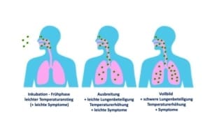 Corona-Lungenentzündung