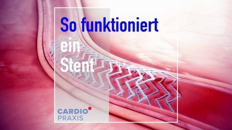 Enge Herzarterien: Stent, Bypass oder nur Medikamente? | Cardiopraxis