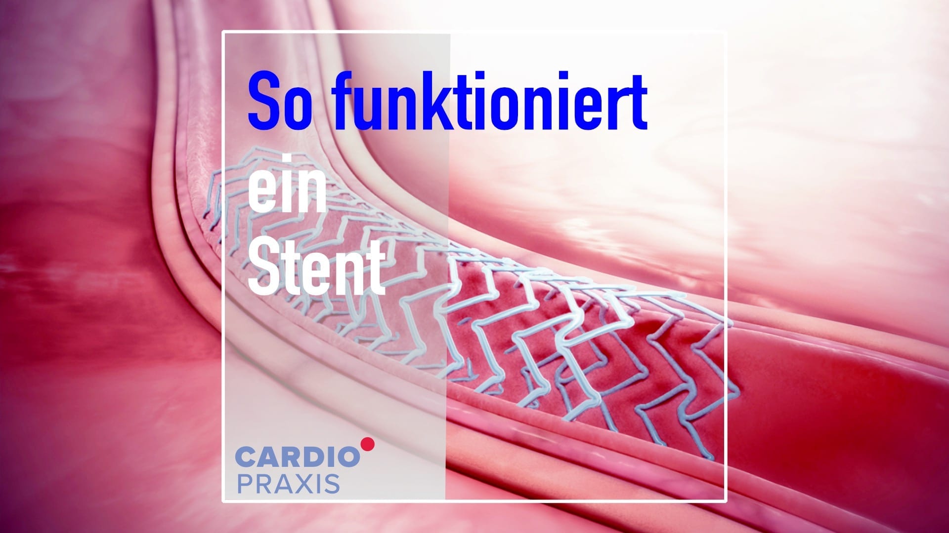 Stent,Was ist ein Stent?,Stent Herz,Gefäßstütze