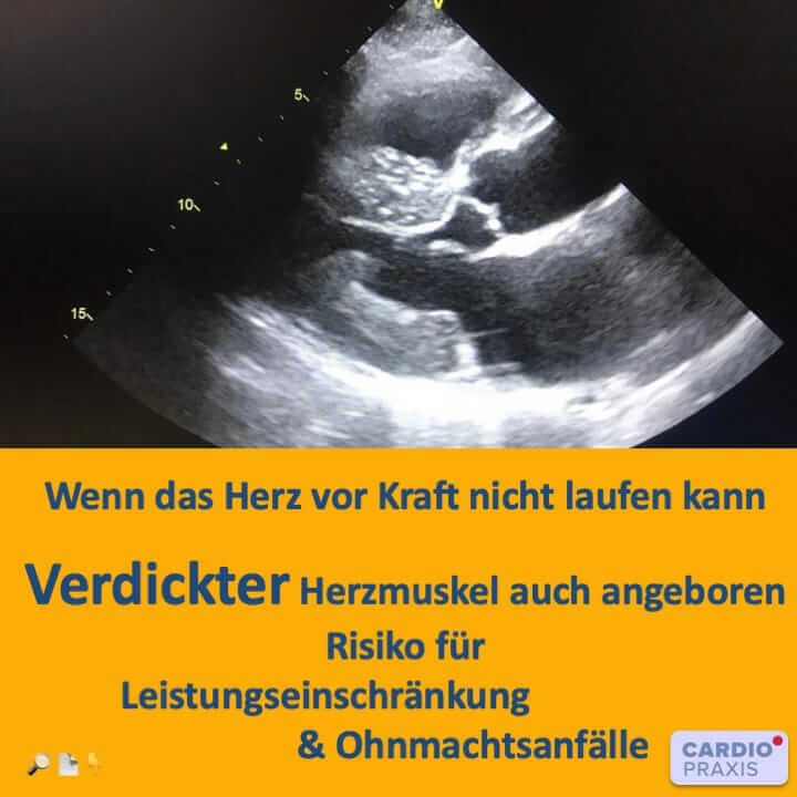 Hypertrophe Kardiomyopathie - Verdickter Herzmuskel auch angeboren - Risiko für Leistungseinschränkung und Ohnmachtsanfälle