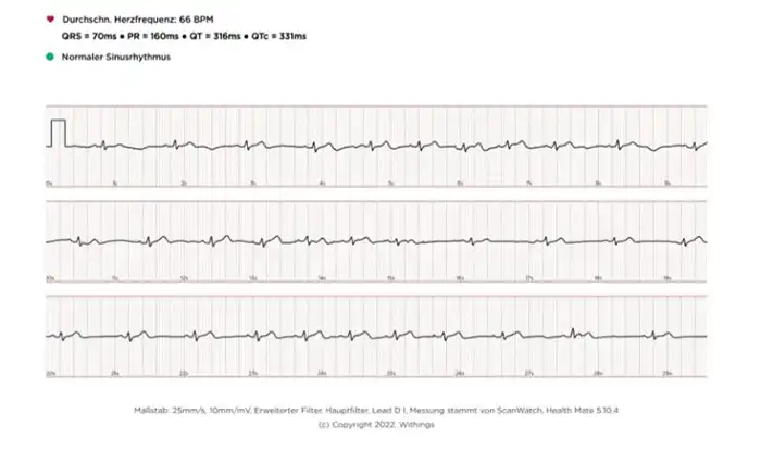 Normaler Sinusrhythmus mit Beschleunigung der Herzfrequenz bei Einatmung und Verlangsamung bei Ausatmung)