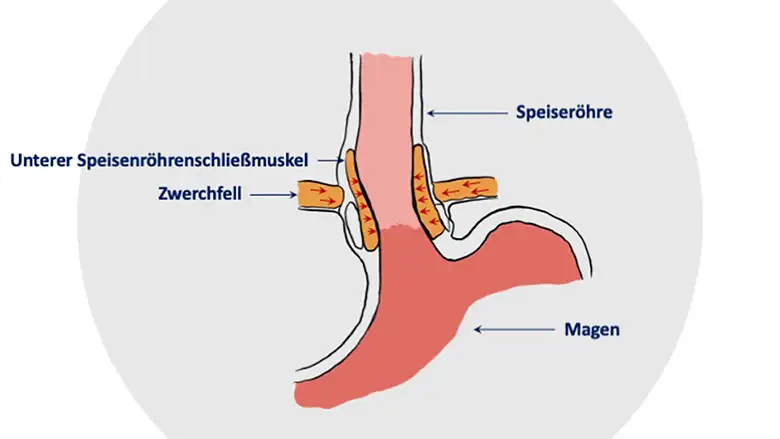 zwerchfell reflux sodbrennen