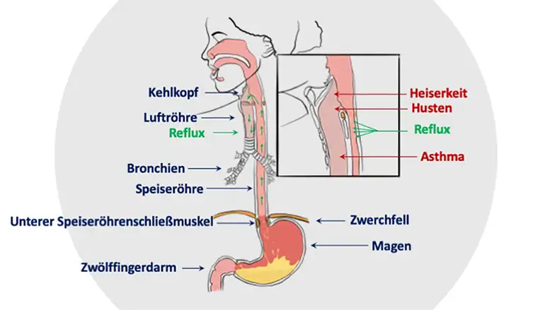 zwerchfell stiller reflux sodbrennen