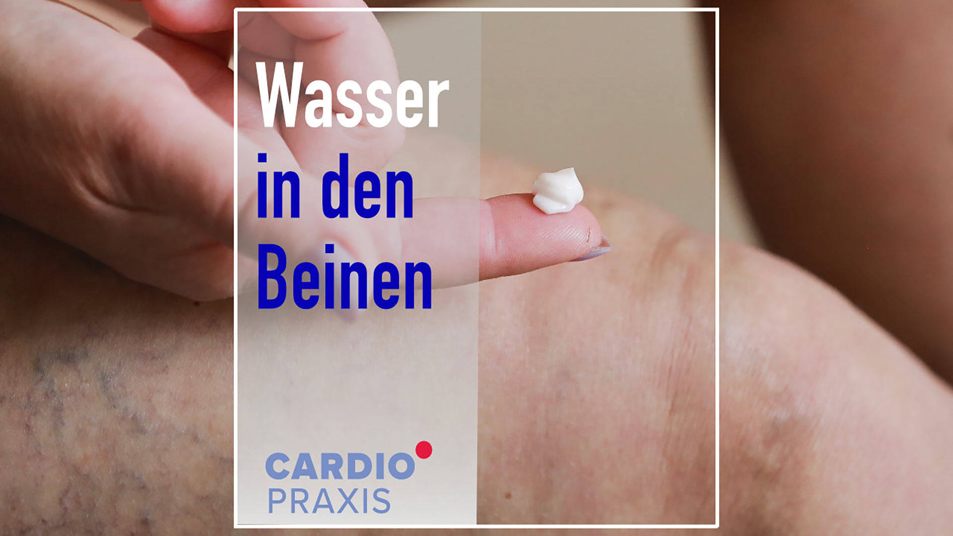 wasser in den beinen beinoedeme