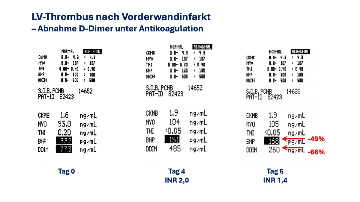 Herzinfarkt,Myokardinfarkt,Entzündung,Komplikationen,Herzwandruptur,Thrombusbildung,Antikoagulation,Aneurysma,Remodelling,Herzinsuffizienz