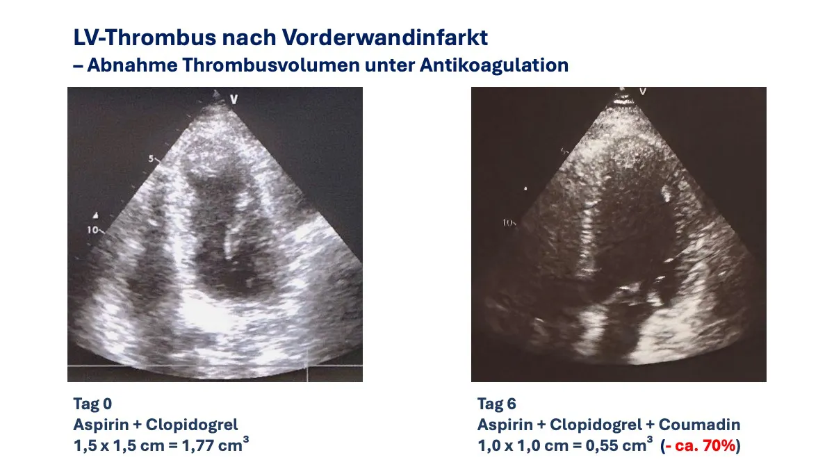 Herzinfarkt,Myokardinfarkt,Entzündung,Komplikationen,Herzwandruptur,Thrombusbildung,Antikoagulation,Aneurysma,Remodelling,Herzinsuffizienz